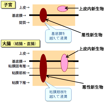 上皮内のイメージ